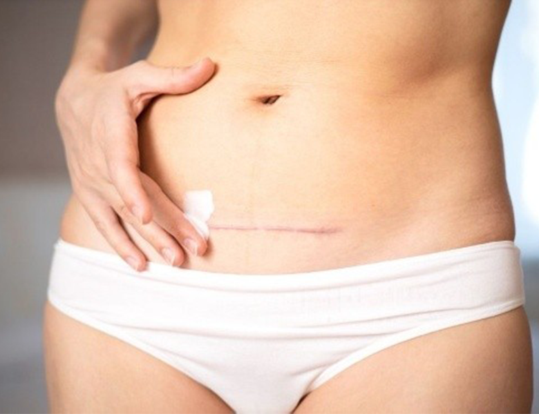 Péče o jizvu - Kurz